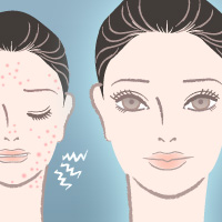 services_acne_scar_treatment